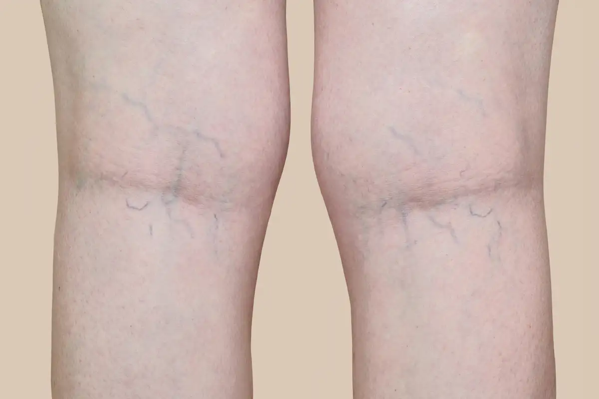 Spider Vein Removal Before