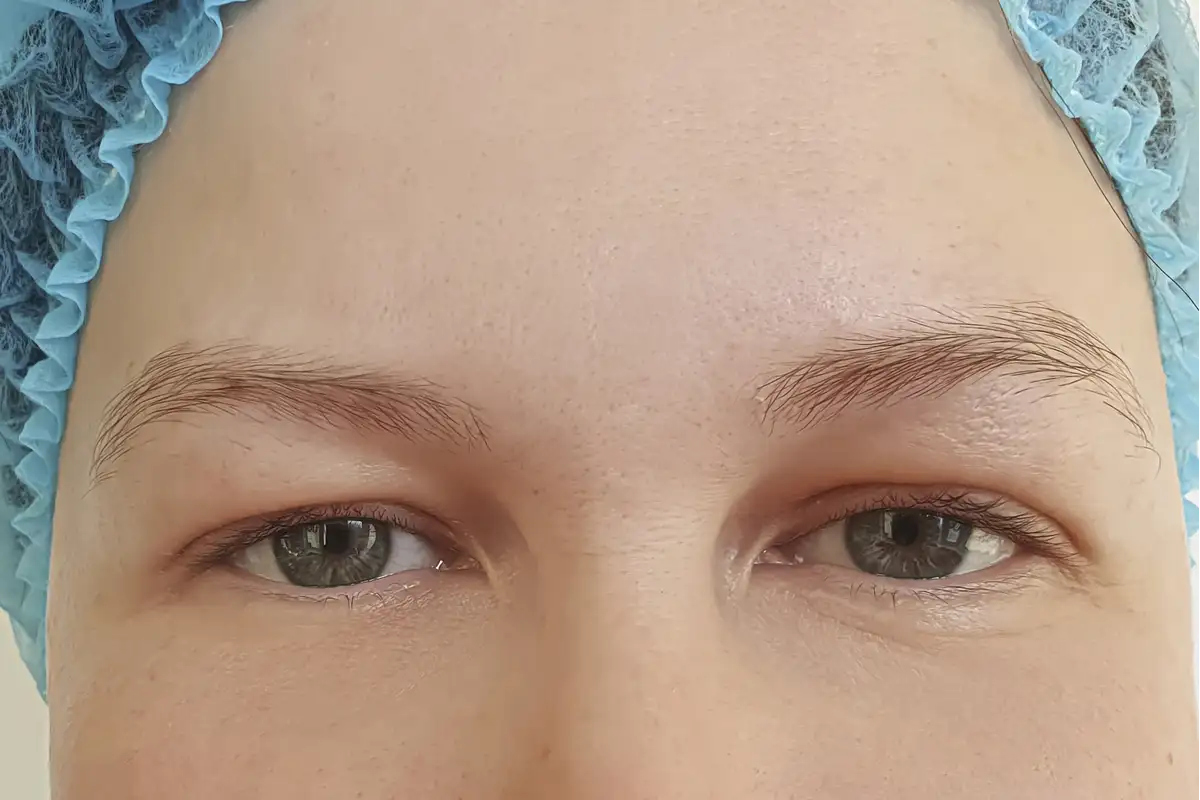 Microdermabrasion After
