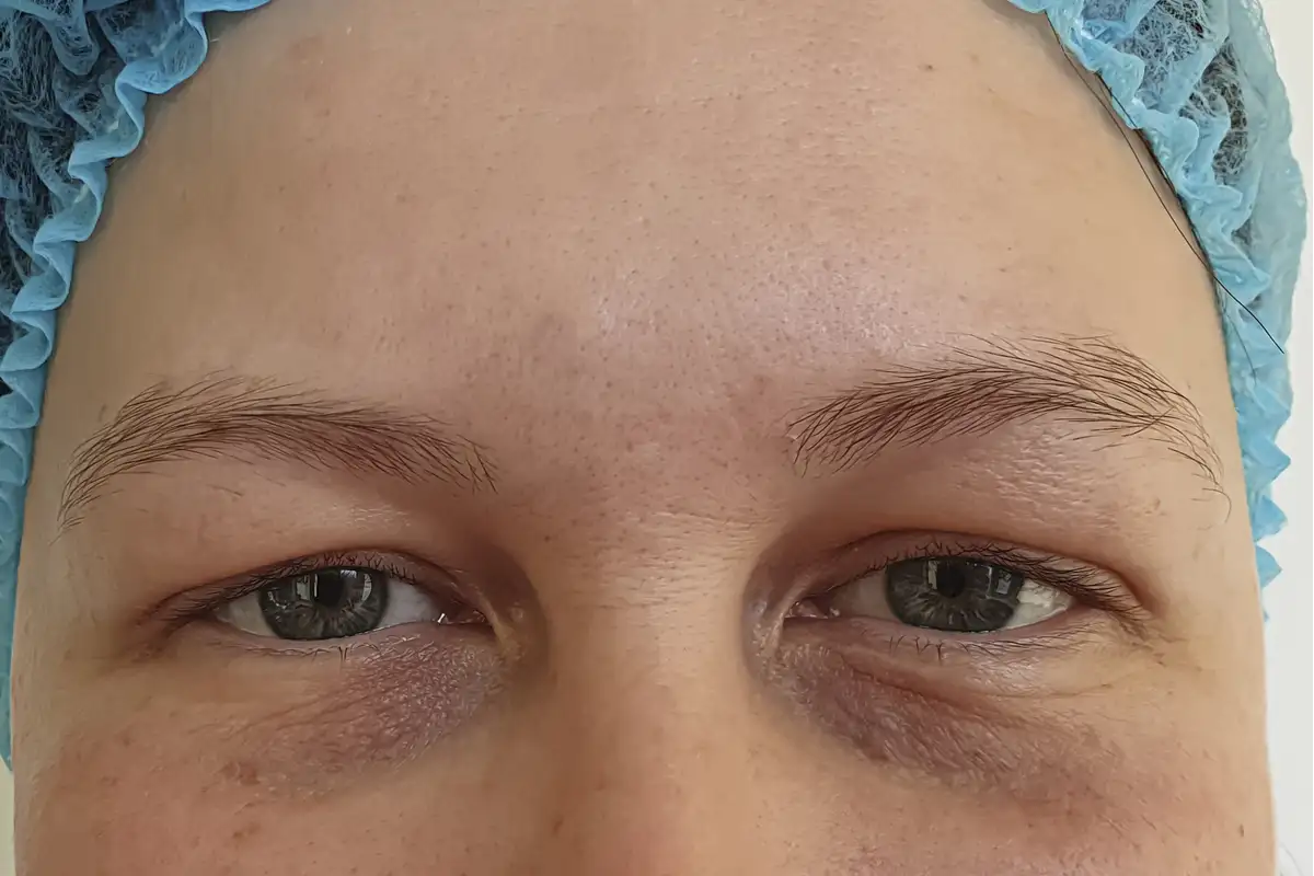 Microdermabrasion Before