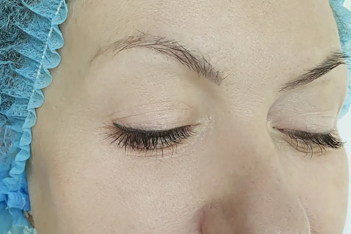 Microdermabrasion After