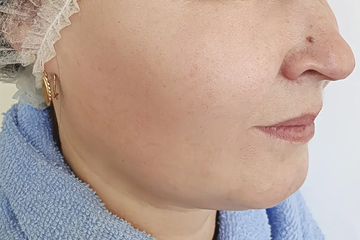 Microdermabrasion After