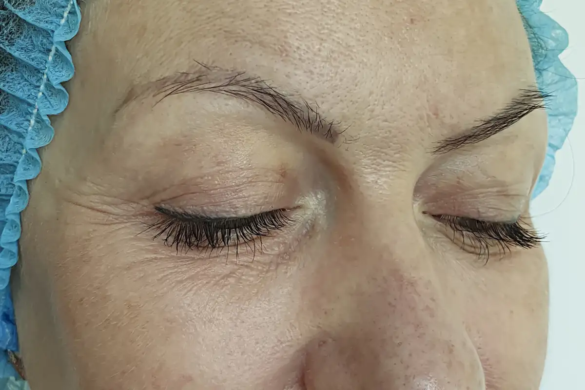Microdermabrasion Before