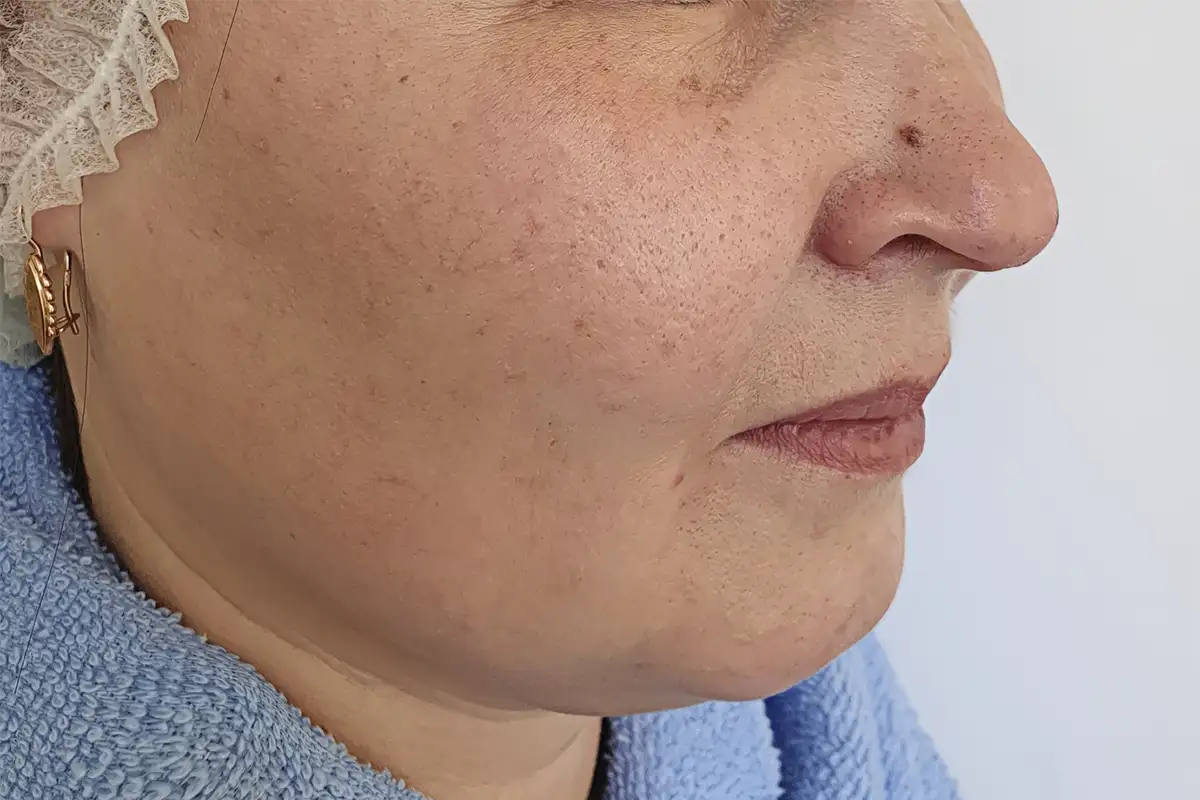Microdermabrasion Before