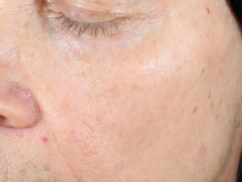 IPL/Photofacial After