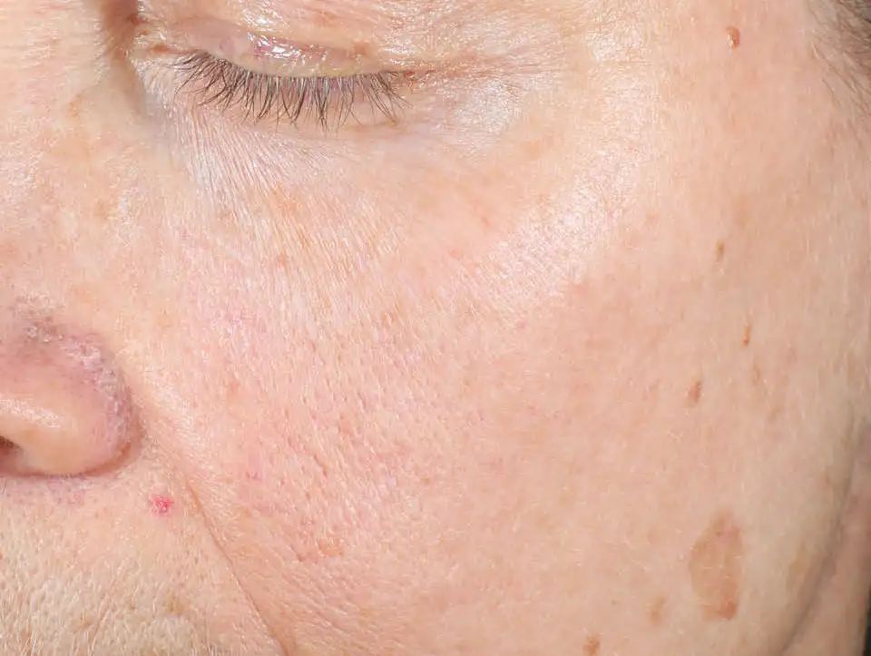 IPL/Photofacial Before