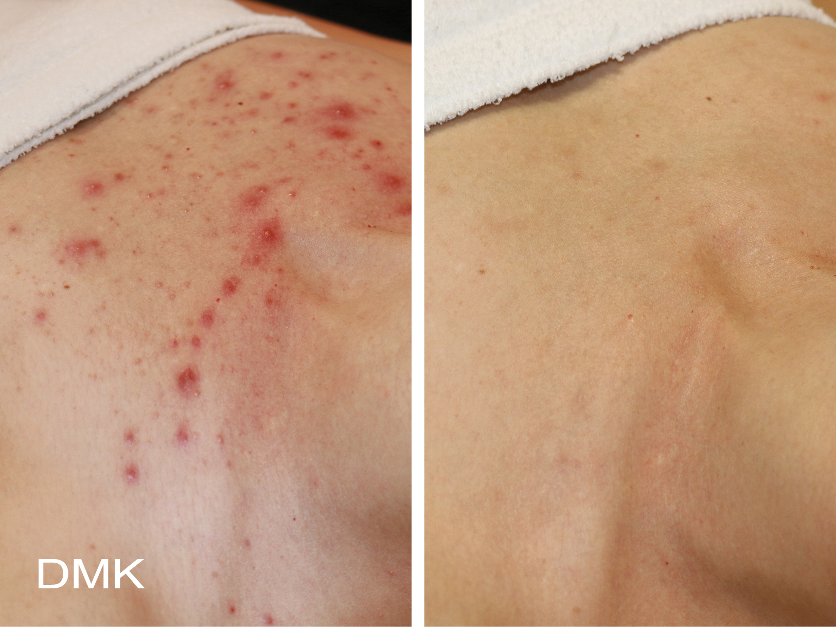 DMK Body Enzyme Therapy Chest Before and Aftrer