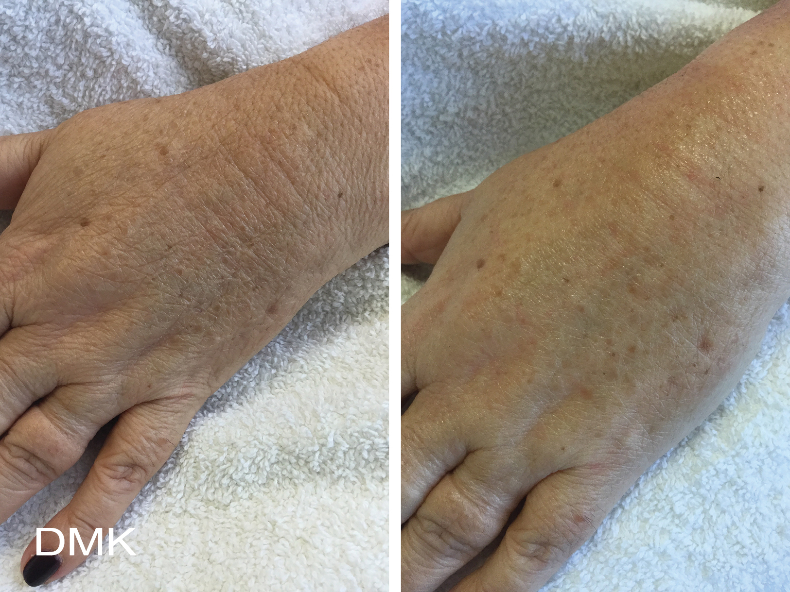 DMK Body Enzyme Therapy Wrinkles Before and Aftrer