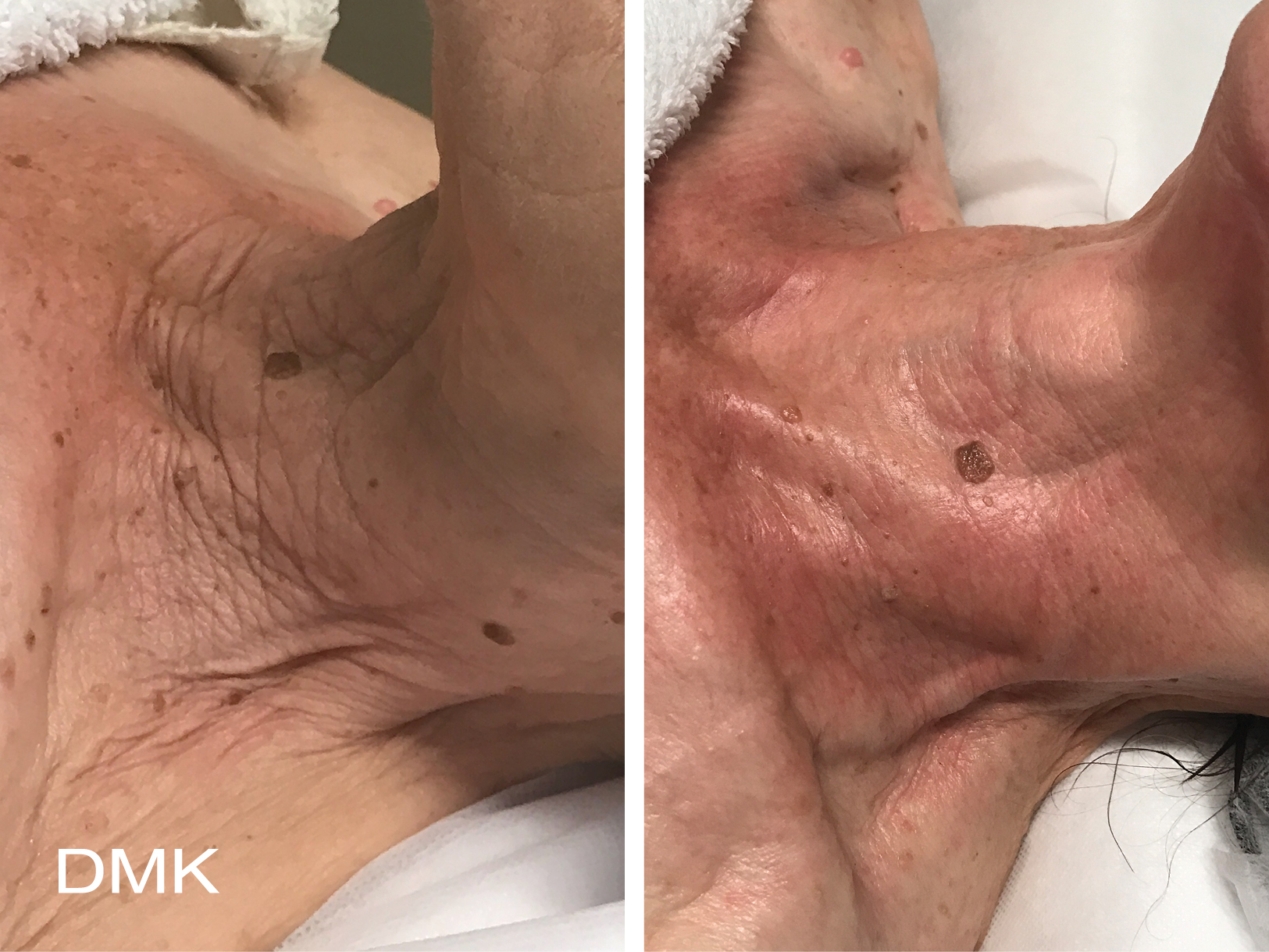 DMK Body Enzyme Therapy Neck Wrinkles Before and Aftrer