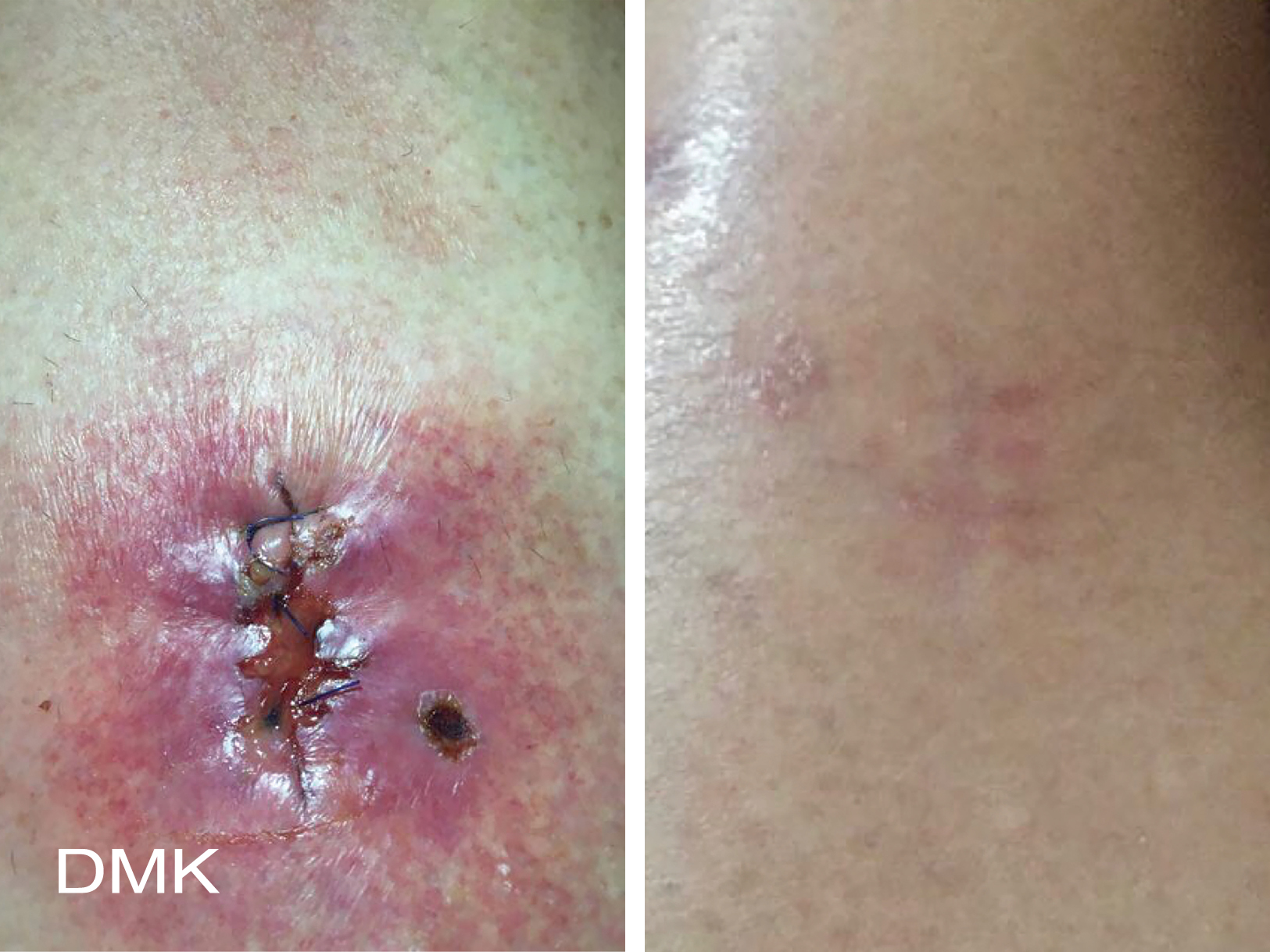 DMK Body Enzyme Therapy Neck Scar Before and Aftrer