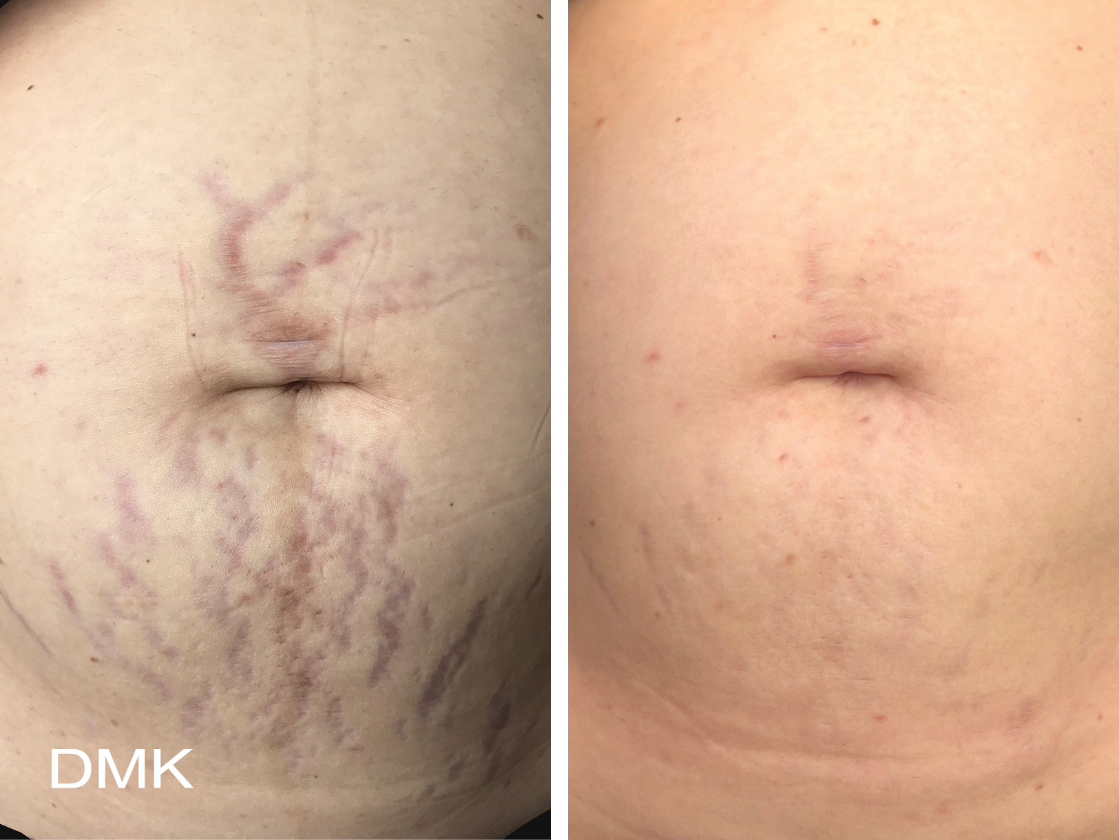 DMK Body Enzyme Therapy Stretch Marks Before and Aftrer