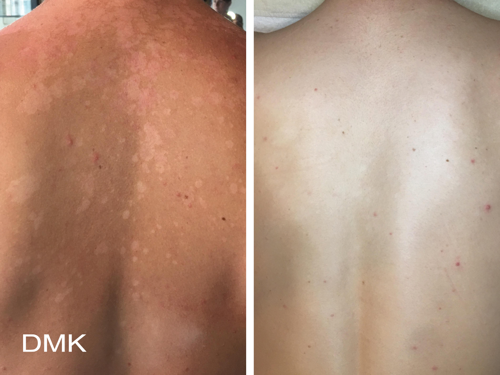 DMK Body Enzyme Therapy Pigmentation Before and Aftrer