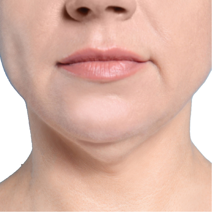 iShape_Before-and-After_NEW-13 iShape Body Contouring for Women - before image