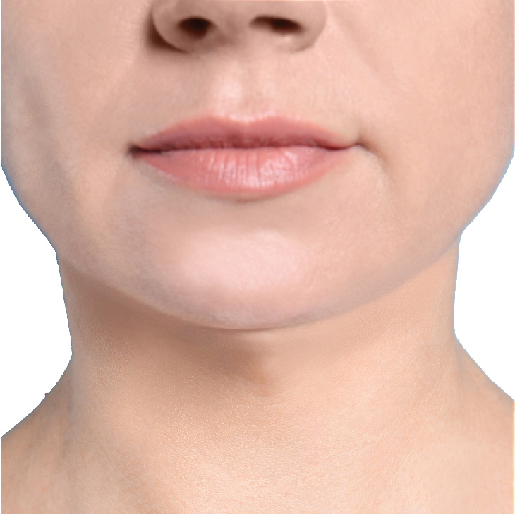 iShape_Before-and-After_NEW-14 iShape Body Contouring for Women - after image