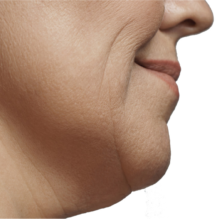 iShape_Before-and-After_NEW-31 Body Contouring Before and After