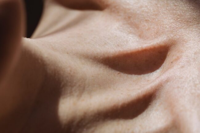 Skin Tags, Skin Tag Removal Palm Beach Gardens