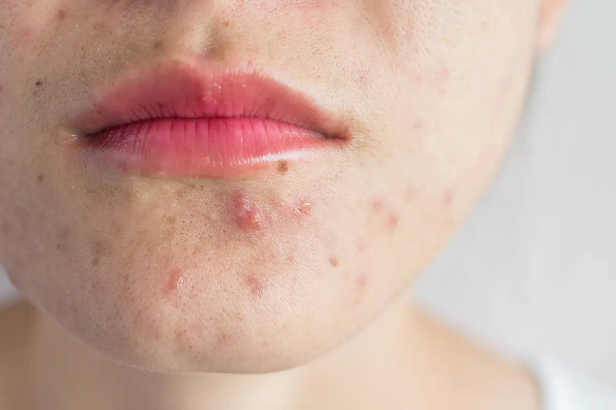 Acne Treatment Palm Beach Gardens