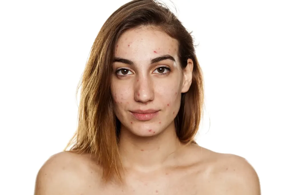 Acne Treatment Near Me
