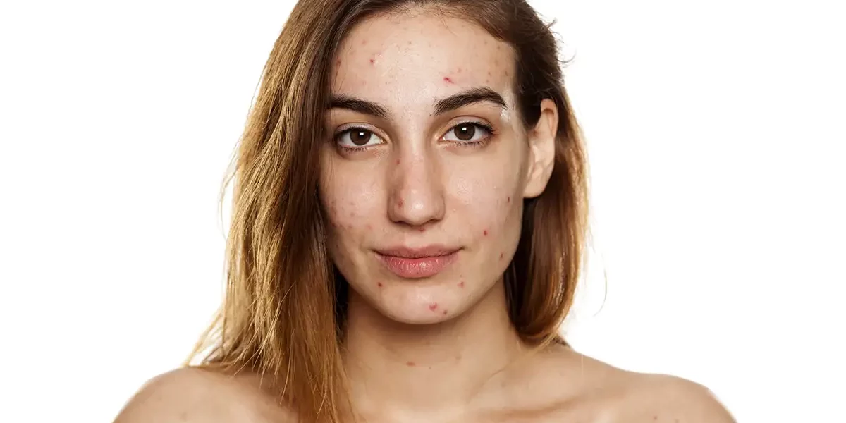 Acne Treatment Near Me