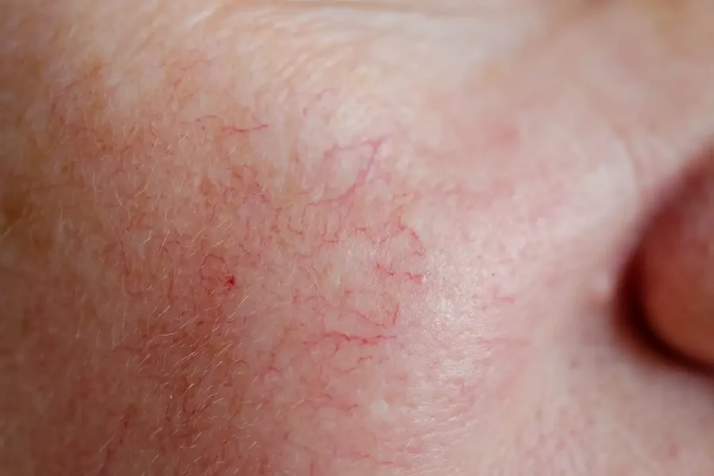 Broken Capillaries Treatment Palm Beach Gardens