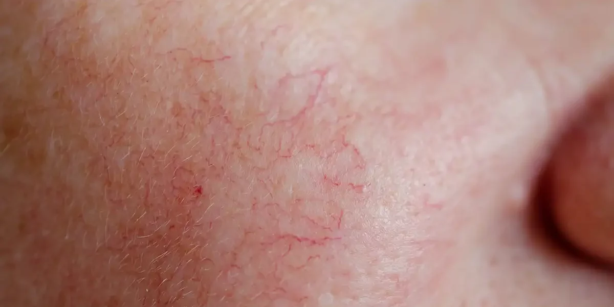 Broken Capillaries Treatment Palm Beach Gardens