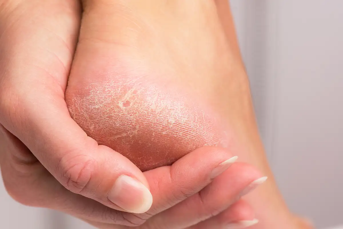 Conditions-Callused-Feet Foot Callus Treatment Palm Beach Gardens