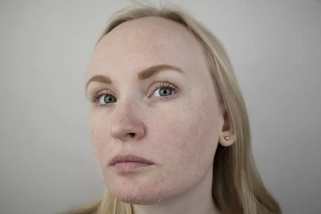 Dry Skin Treatment Palm Beach Gardens