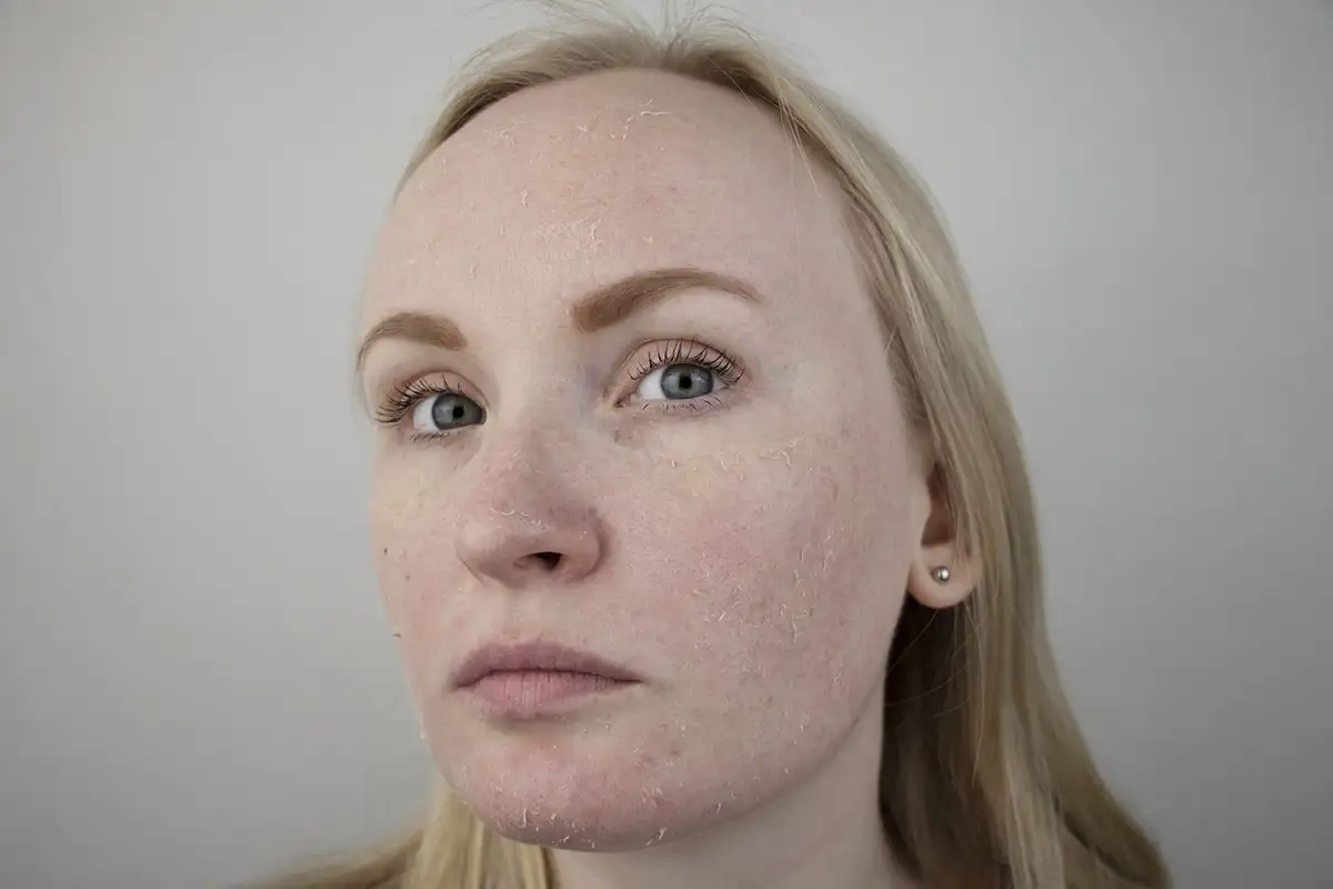 Conditions-Dry-Skin Dry Skin Treatment Palm Beach Gardens