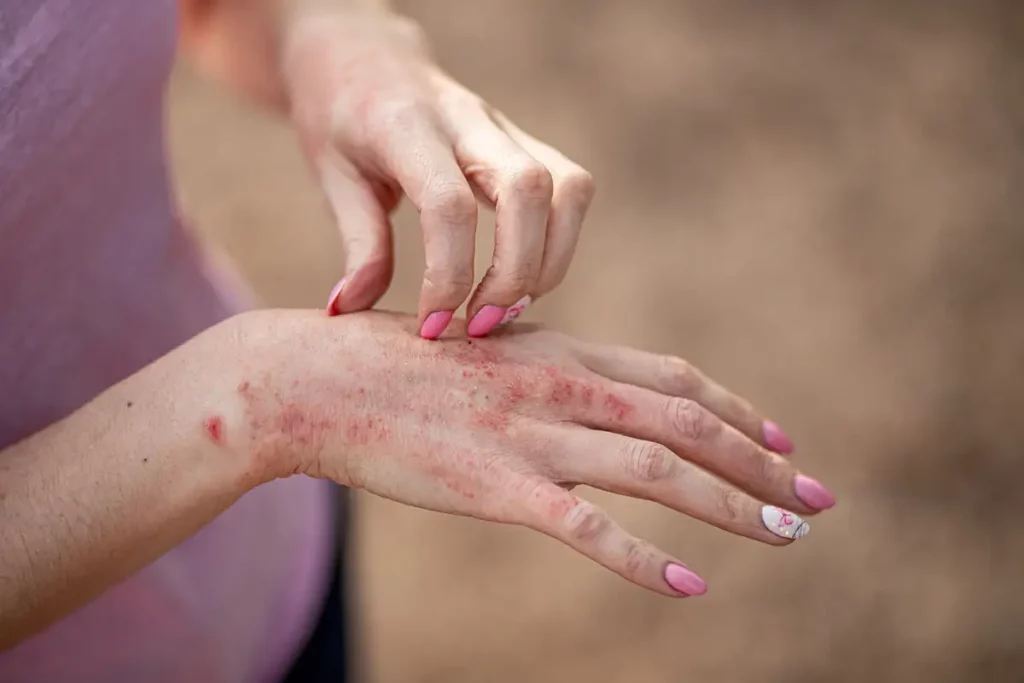 Eczema Treatment Palm Beach Gardens