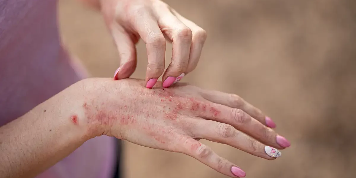 Eczema Treatment Palm Beach Gardens