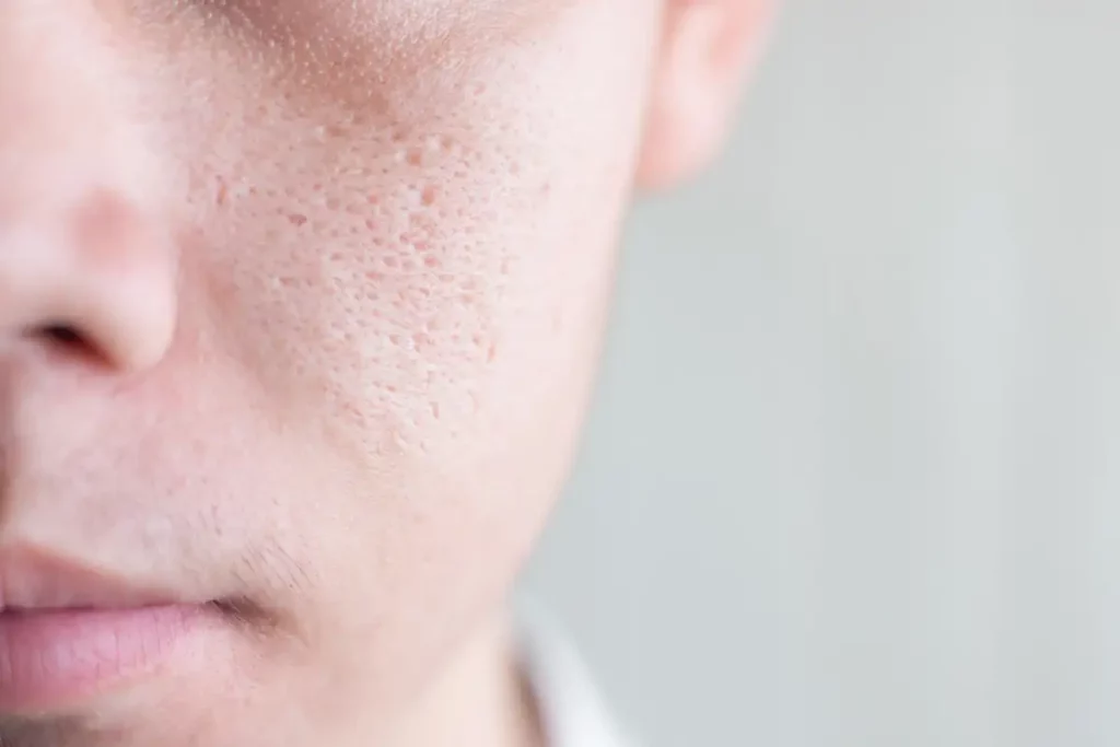 Large Pores Treatment Palm Beach Gardens