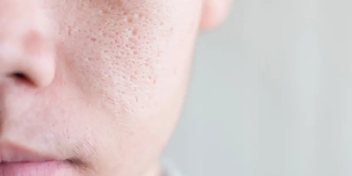 Large Pores Treatment Palm Beach Gardens