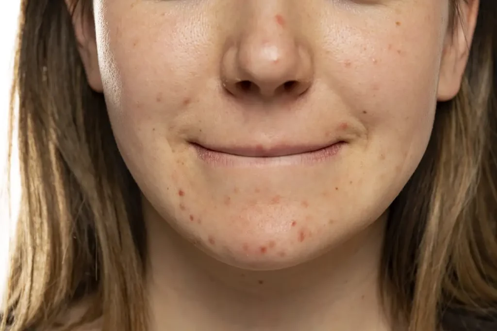 Oily Skin Treatment Palm Beach Gardens