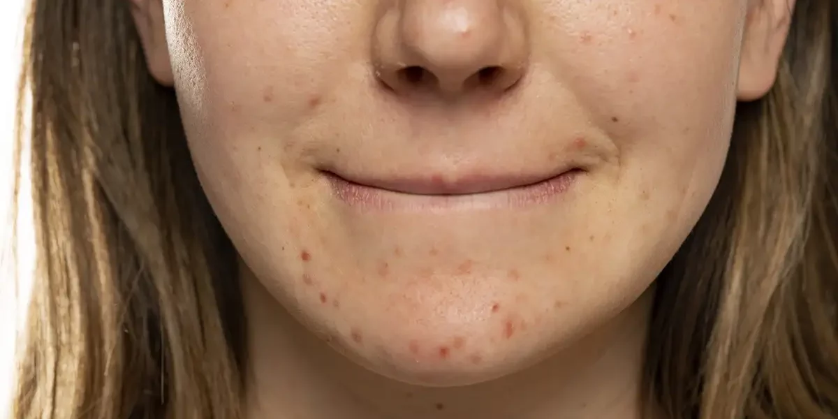 Oily Skin Treatment Palm Beach Gardens