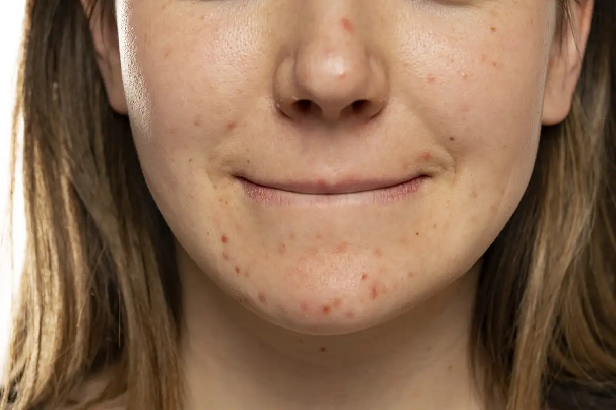 Conditions-Oily-Skin Oily Skin Treatment Palm Beach Gardens