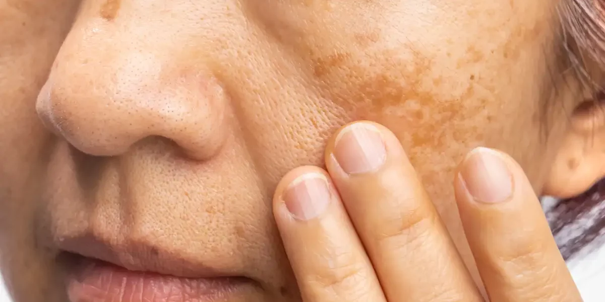 Melasma Skin Treatment