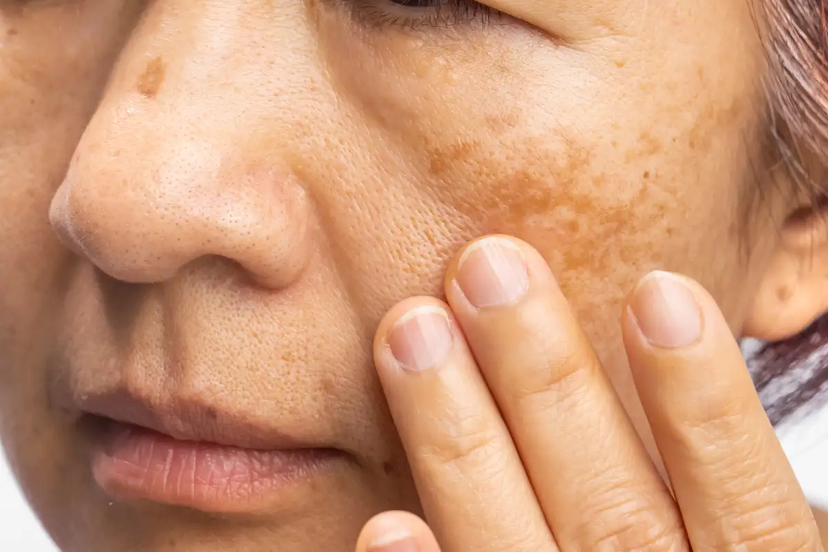 Melasma Skin Treatment