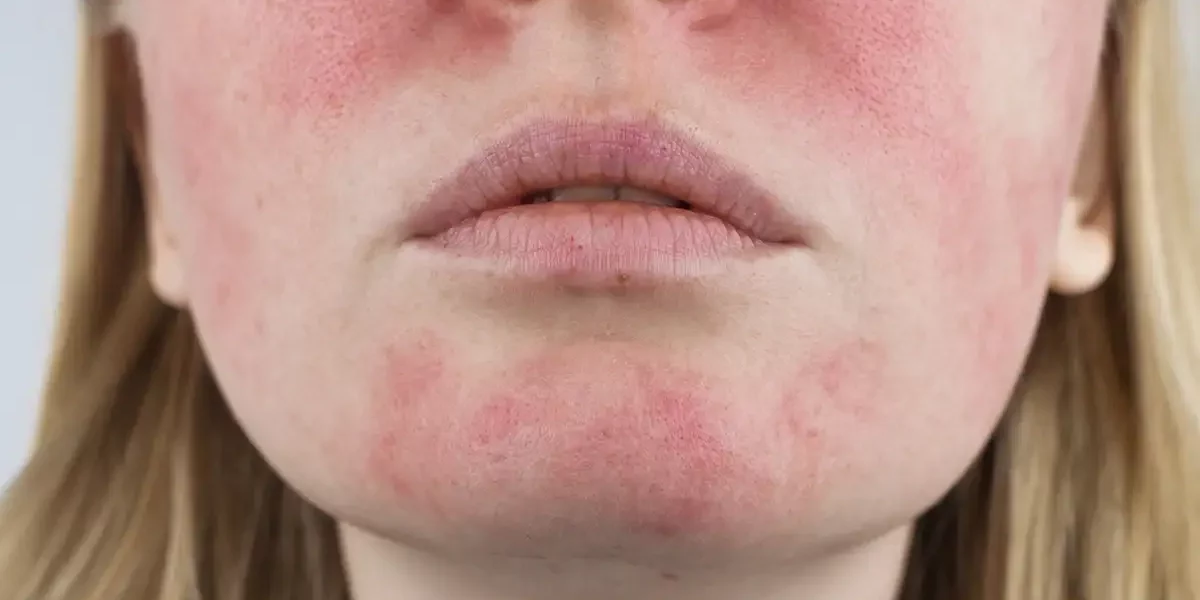 Facial Redness Treatments Palm Beach Gardens