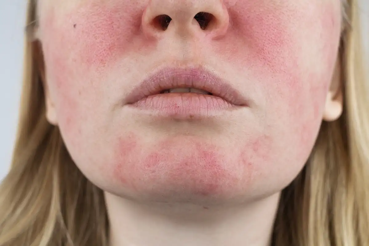 Conditions-Redness2 Facial Redness Treatments Palm Beach Gardens