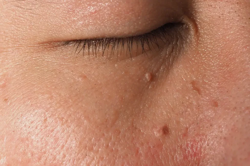 Skin Tag Removal Palm Beach Gardens