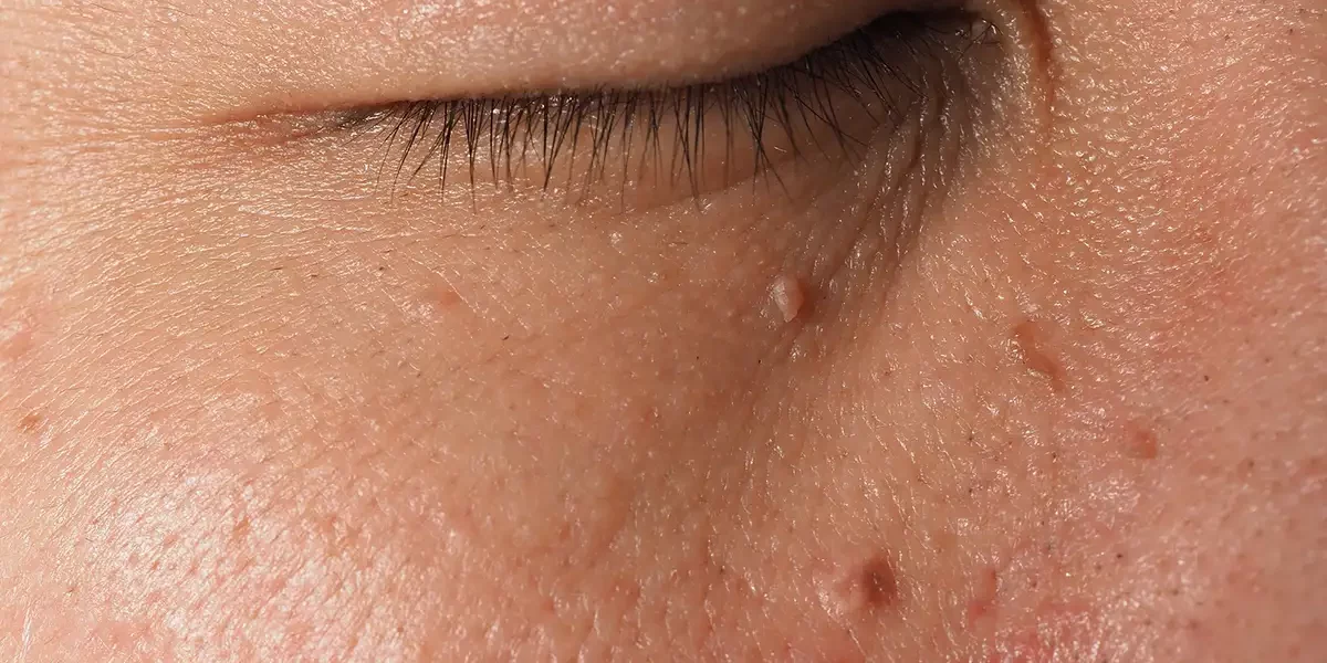 Skin Tag Removal Palm Beach Gardens