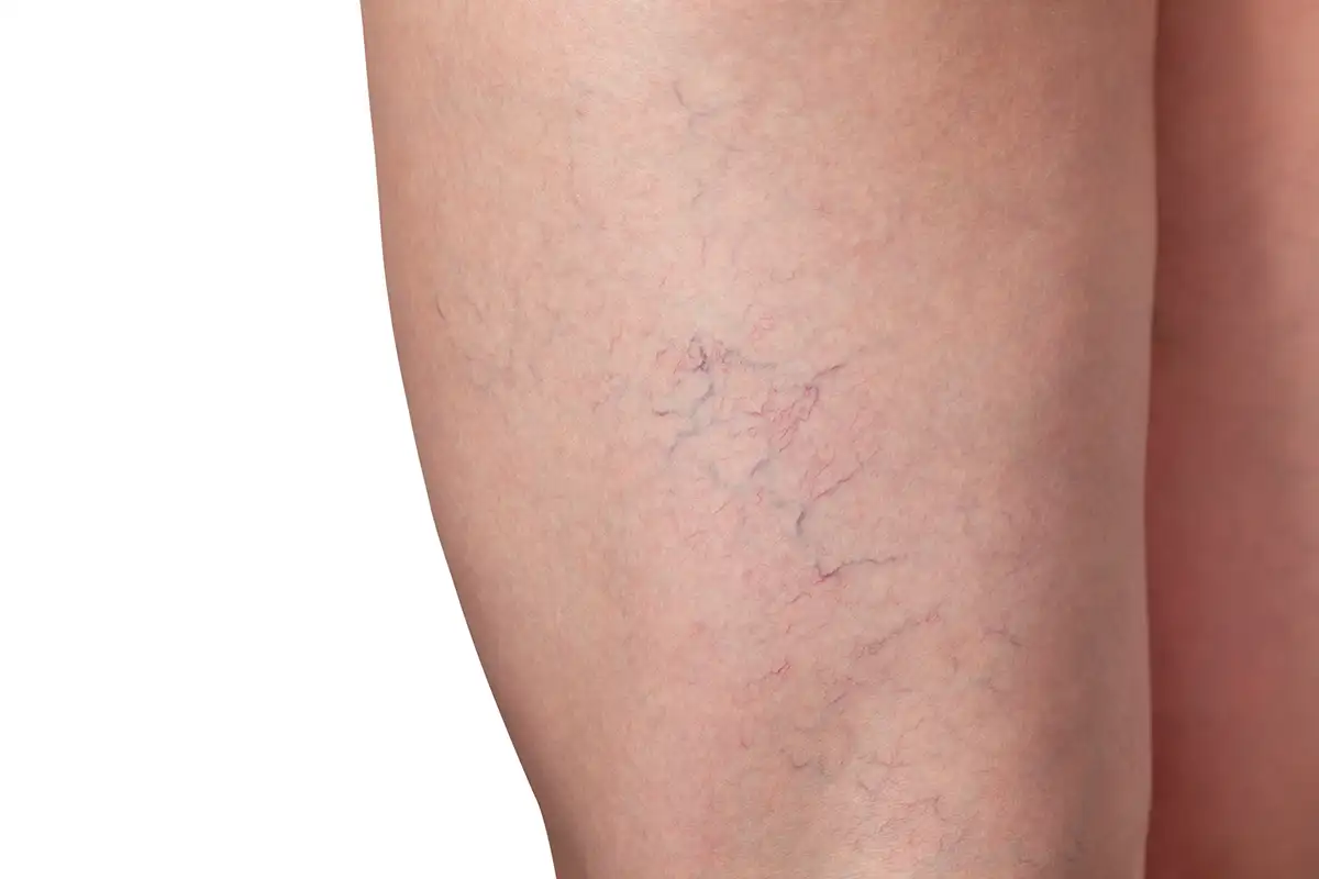 Spider Vein Removal Palm Beach Gardens