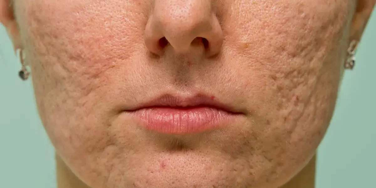 Textured Skin
