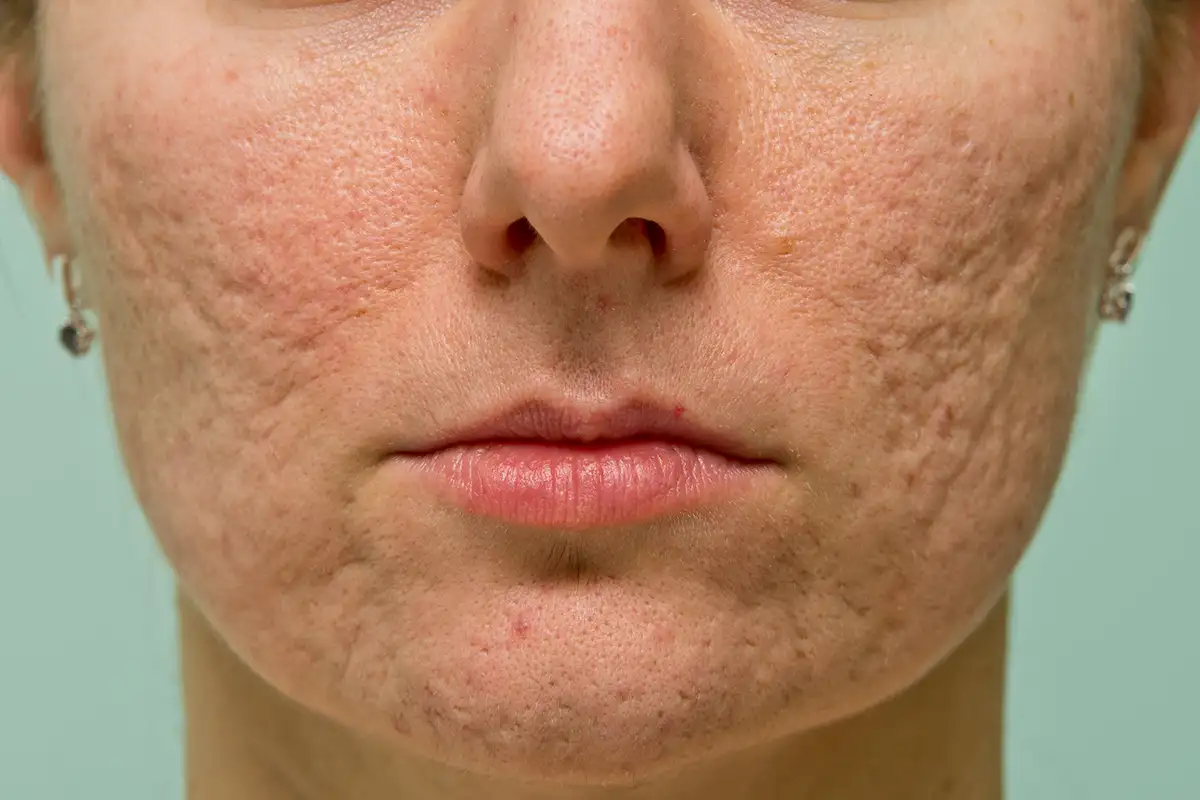 Conditions-Textured-Skin Textured Skin