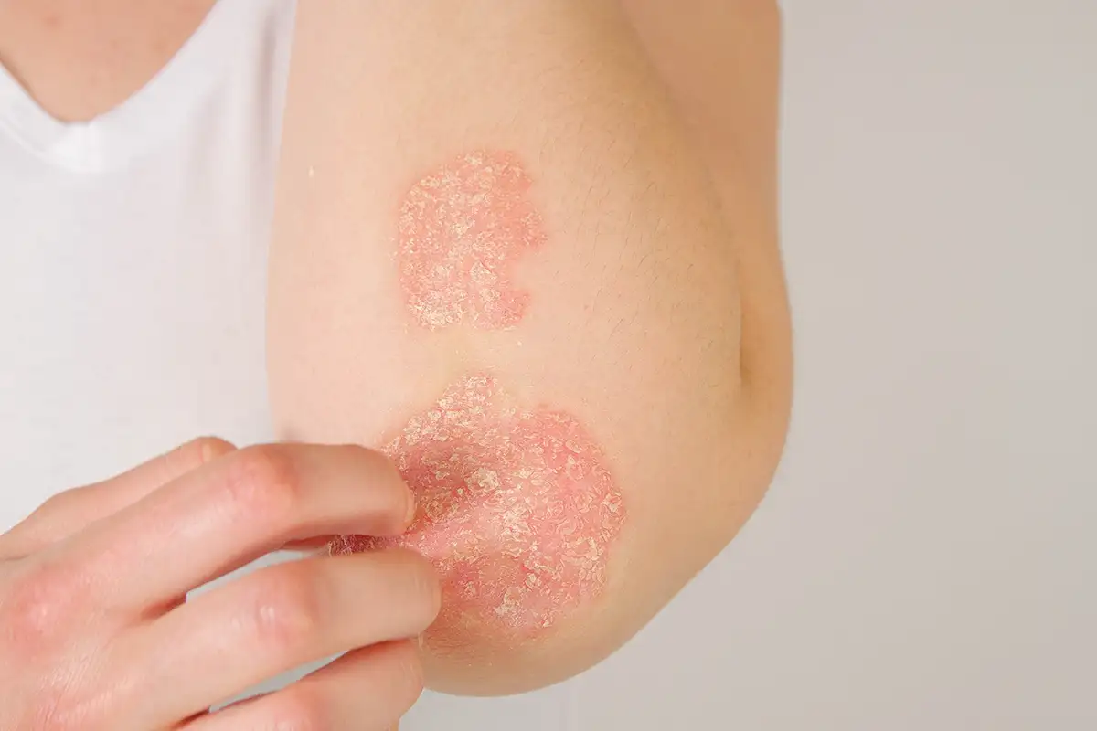Conditions-eczema-psoriasis Psoriasis Treatment Palm Beach Gardens