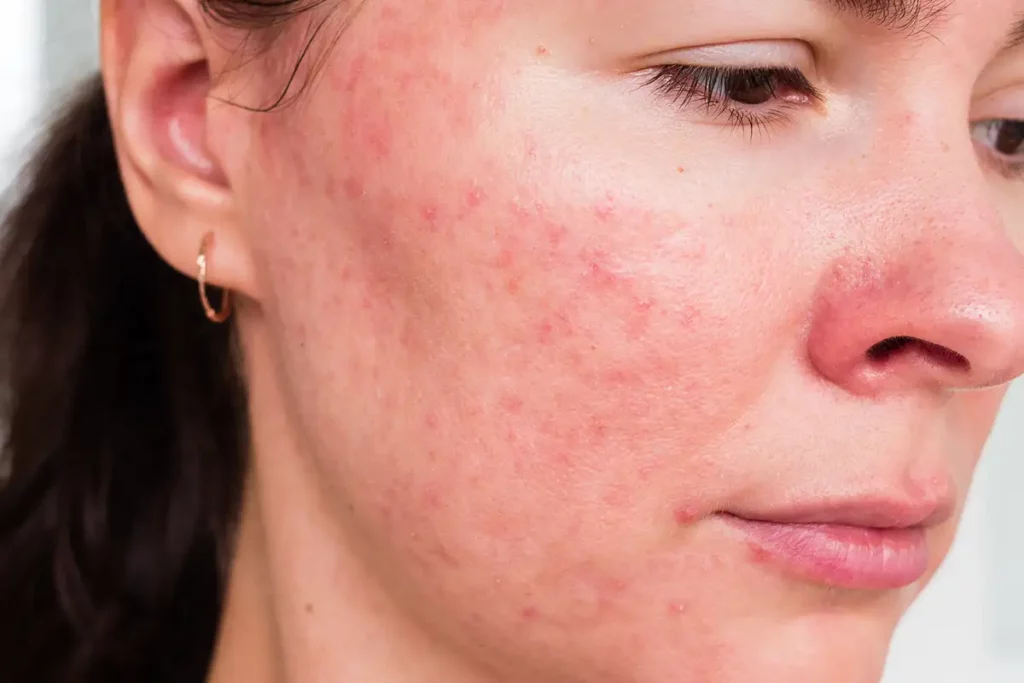 Rosacea Treatment Palm Beach Gardens