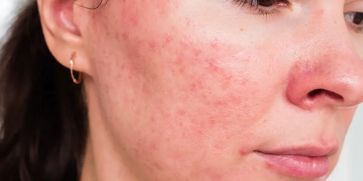 Rosacea Treatment Palm Beach Gardens