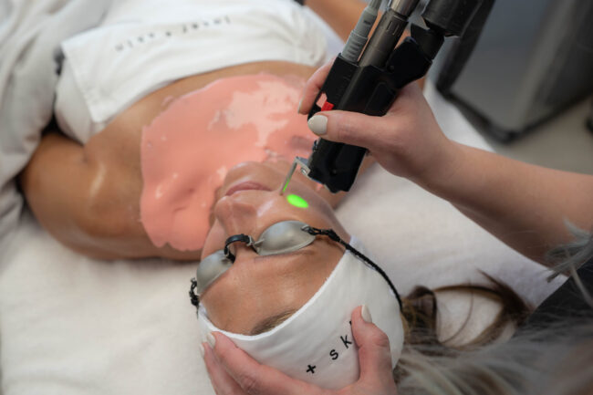 IPL Photofacial, IPL Photofacial Before and After