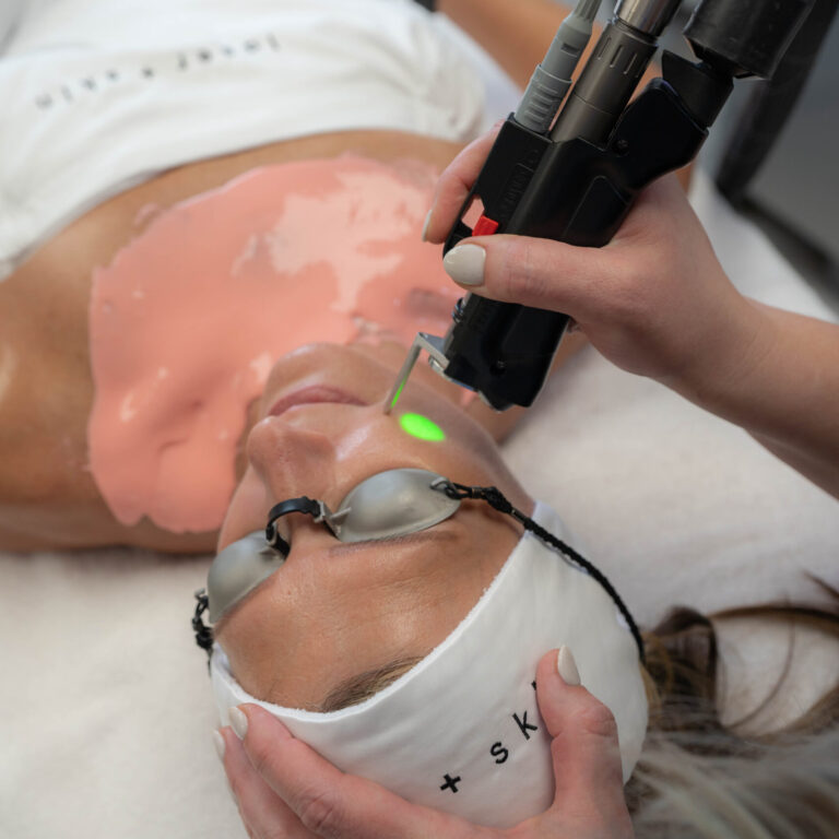 IPL Photofacial, IPL Photofacial Before and After