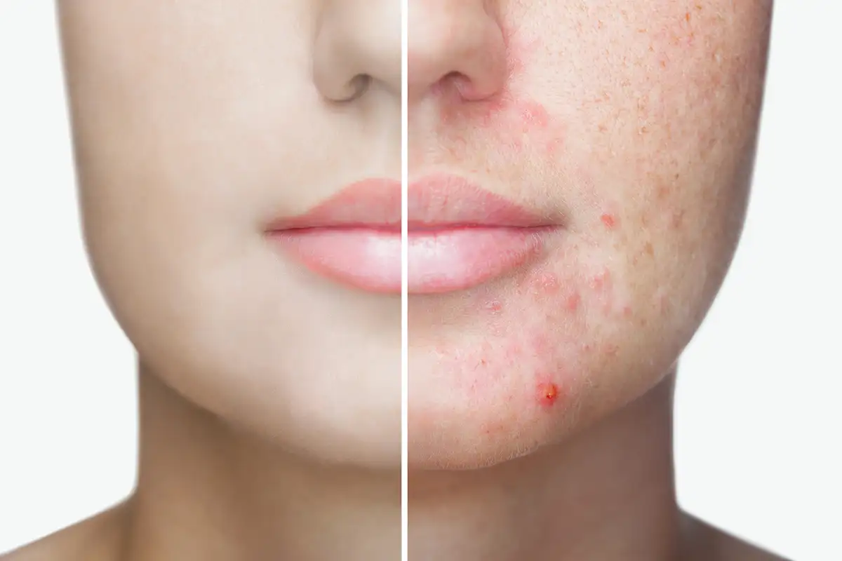Popular Palm Beach acne​ treatment