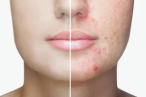 Amazing acne treatment in Palm Beach Gardens, FL